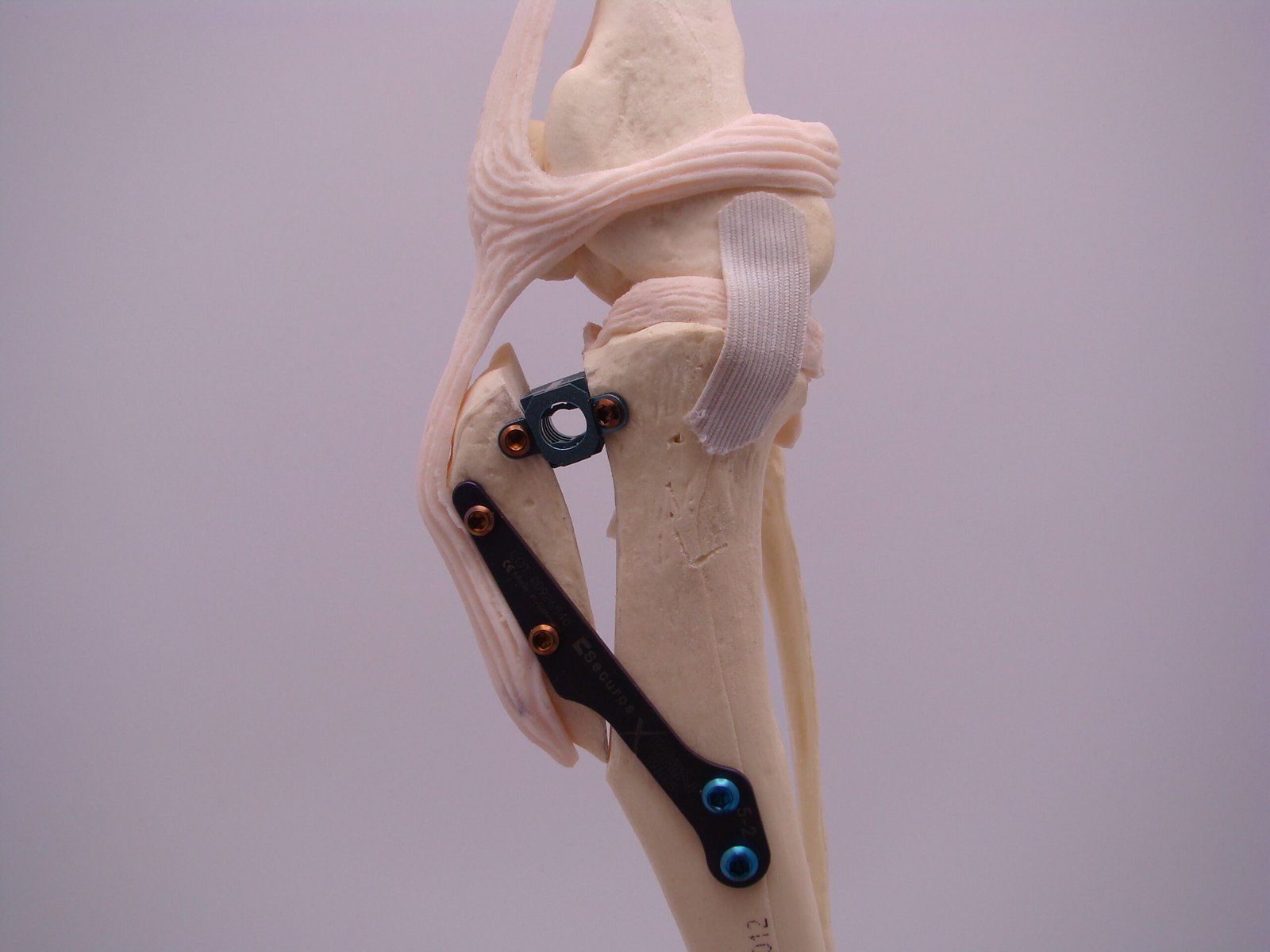Tibial Tuberosity Advancement (TTA)